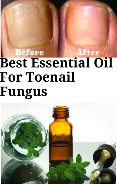 10 Best Essential Oils For Toenail Fungus Remedies Naturallydaily In 10 Best Essential Oils For Toenail Fungus Remedies Naturallydaily In