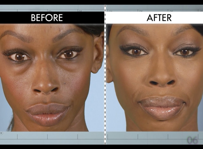 Bad Bags From Botched Patients Before And After Shocking Images Bad Bags From Botched Patients Before And After Shocking Images