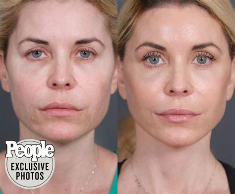 Bad Face Fillers Gone Wrong