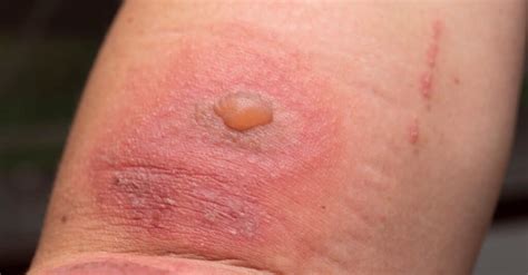 Beetle Blister Bite