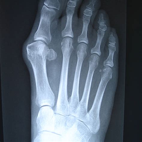 5 Bunion Signs