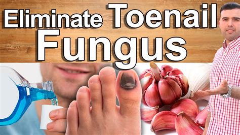 Garlic To Heal Your Toenail Fungus At Home Overnight Youtube Garlic To Heal Your Toenail Fungus At Home Overnight Youtube