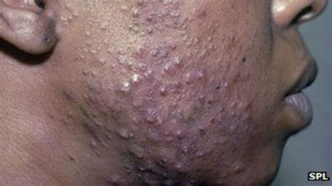 Pimples on Black Skin Pimples on Black Skin