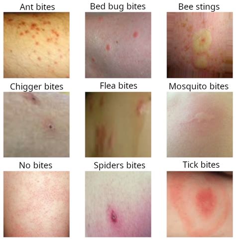 Rash vs Bed Bugs Symptoms