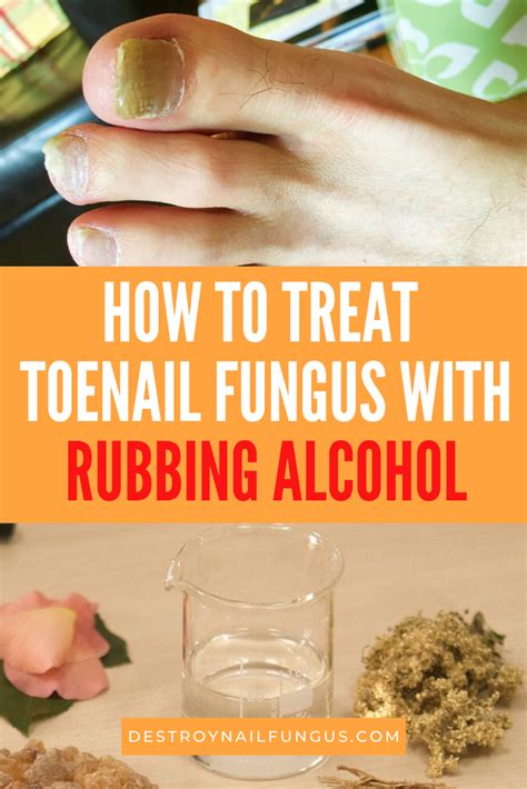 5 Ways to Cure Nail Fungus