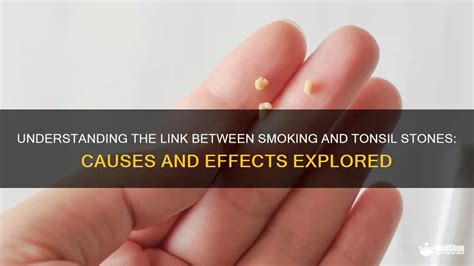 Tonsil Stones and Smoking