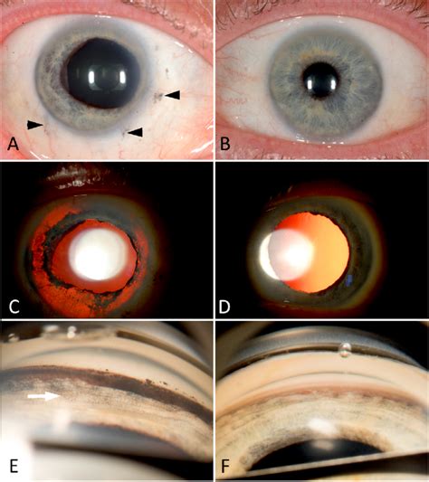 Transillumination Of The Iris